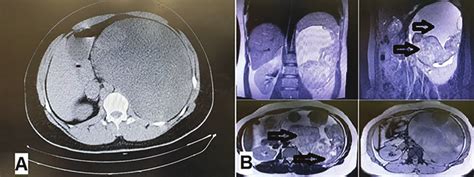 Abdominopelvic Ct Scan With Iv Contrast A And Abdominopelvic Mri With