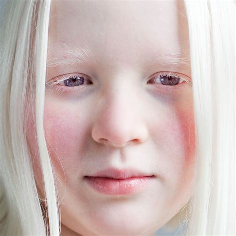O Albinismo é Um Distúrbio Genético Que Se Caracteriza AskSchool