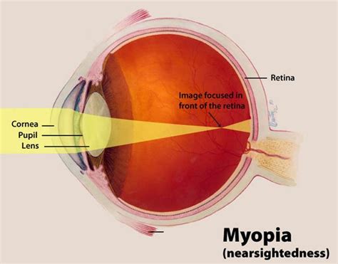 It can be easy to prevent myopia from getting worse once you know what causes it. Myopia (short-sighted) - Causes, Symptoms & Treatments