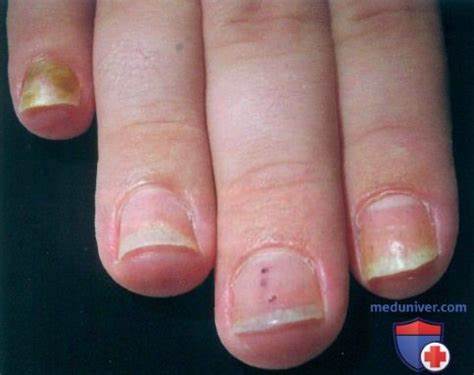 Псориаз без диет