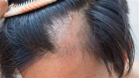 J am acad dermatol 1985; Alopecia Areata: Causes, Symptoms, Management and Clinical ...