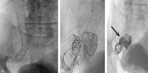 Percutaneous Retrograde Embolization From Superior Gluteal Artery For Download Scientific