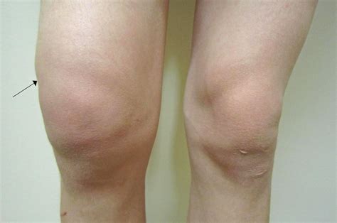 Water On The Knee Knee Effusion Treatment Symptoms And Causes