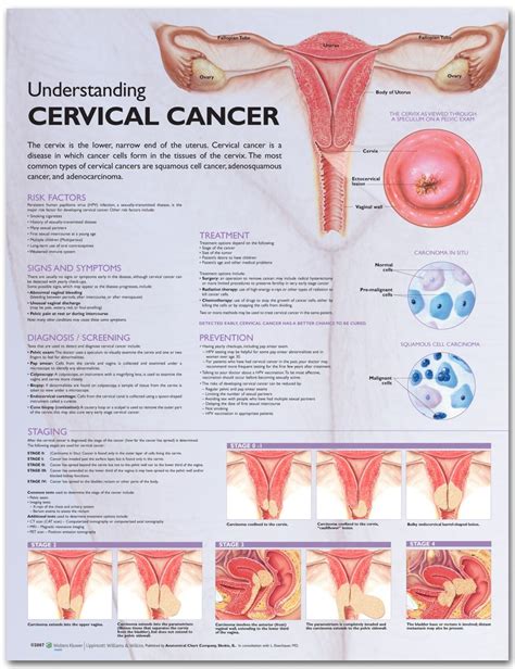Cervical Cancer Diagram