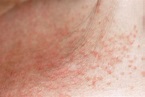 How to Get Rid of Heat Rash (Prickly Heat) - Riverchase Dermatology