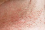 How to Get Rid of Heat Rash (Prickly Heat) - Riverchase Dermatology