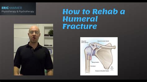 How To Rehab A Humeral Fracture Magazine Lets Talk About It