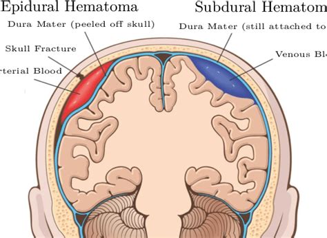 9 Schematic Representation Of An Epidural And Subdural Hematoma