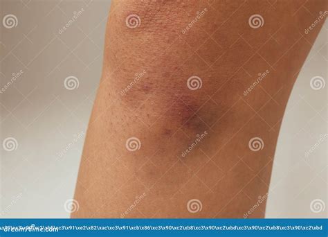 Hematoma And Large Bruise Blood Under Skin Congestion Stock Photo