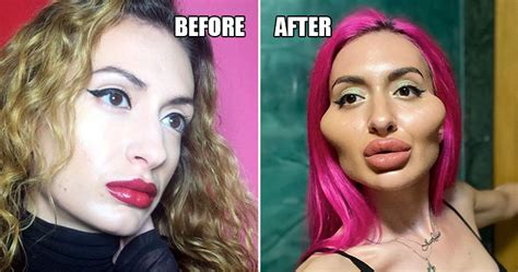 Instagram Influencer Gets Giant Cheekbones After Injecting Her Face With Fillers