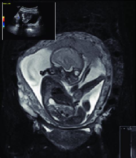 Mri Coronal View Showing Bladder Tumour In Pregnancy Download