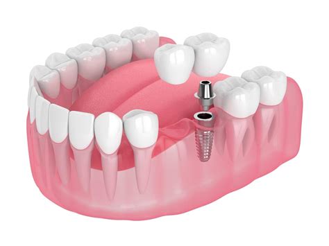 Replacing Lost Teeth With Dental Implants Ankeny Ia