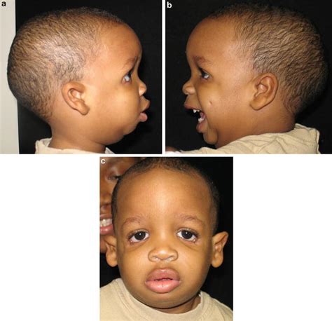 Genetics Of Common Congenital Syndromes Of The Head And Neck Ento Key