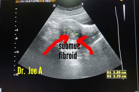 Ultrasound Imaging Submucosal Fibroid Vascular