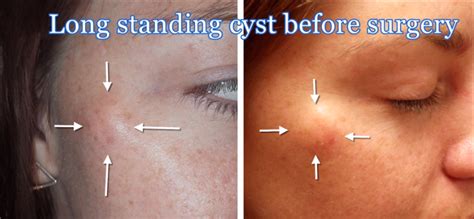 Cosmetic Removal Of A Sebaceous Cyst On The Face