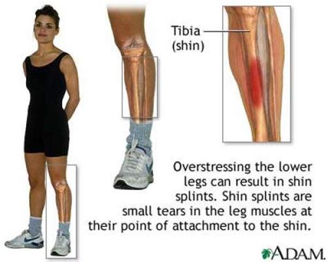 What You Can Do For Shin Splints Shin Splints Shin Splint Exercises