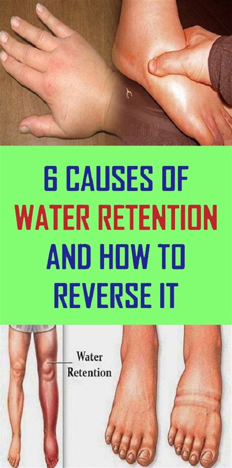 6 Simple And Effective Home Remedies For Water Retention Health