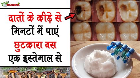 Concentrate on the back and lower teeth, where tartar tends to accumulate most, the doctors book of home remedies recommends. how to get rid of tooth cavity at home 100% Effective ...