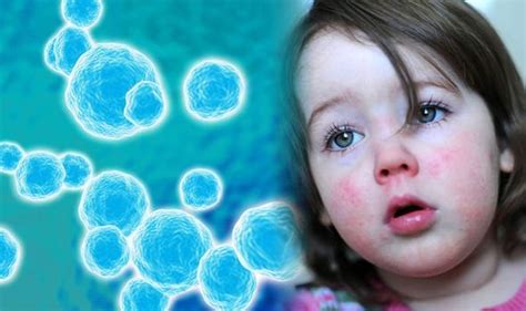 Scarlet Fever Rise In Cases In The Uk What Are The Symptoms