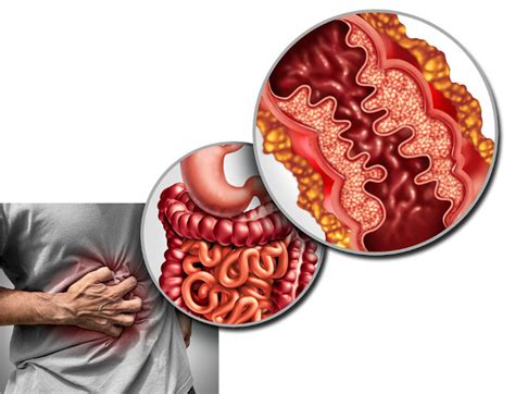 Doença de Crohn o que é causas sintomas Biologia Net