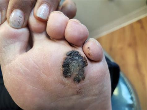 Malignant Melanoma Foot