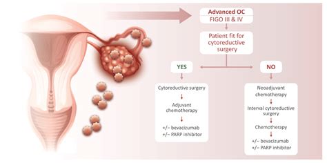 Reprod Med Free Full Text Ovarian Cancer Treatment And