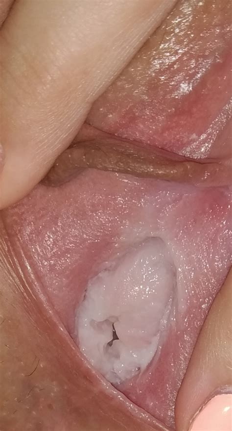 White Coating Inside Vagina Sexual Health Forums Patient