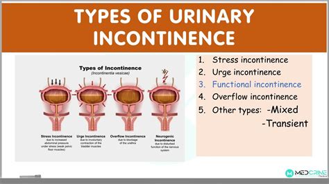 Illustration Depicting Three Types Of Incontinence Overflow Stress Photos