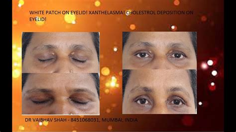 White Patch On Eyelid Xanthelasma Treatment Cholesterol Deposition On Eyelids Youtube