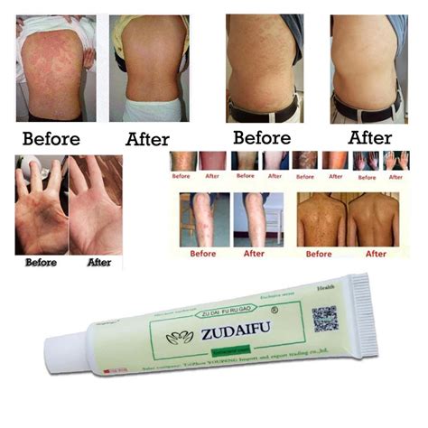 Zudaifu Skin Care Cream Skin Psoriasis Cream Dermatitis Eczematoid