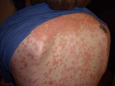 Guttate Psoriasis Causes Homeopathic Treatment