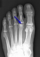 Freiberg's Disease - Foot & Ankle - Orthobullets