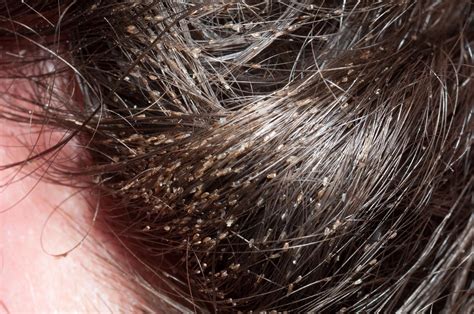 What Lice Beneath The Bmj