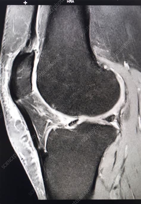 Knee Mri Stock Image C0154109 Science Photo Library