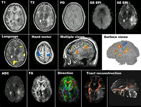 Mri And Medical Imaging Mri And Neurodegenerative Diseases Mri