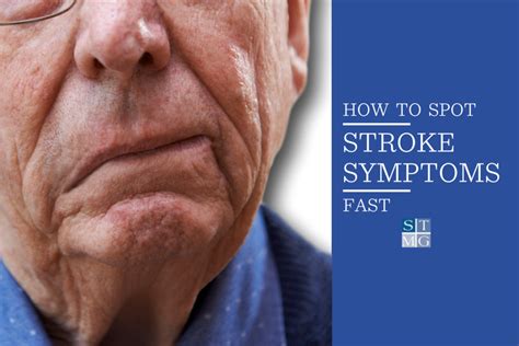 Spot Stroke Symptoms Fast With These Guidelines Stmg Nashville