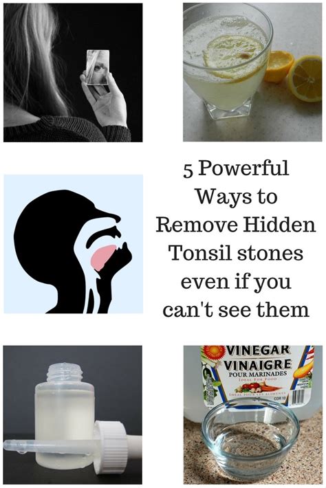 5 Powerful Ways To Remove Hidden Tonsil Stones Even If You Cant See Them