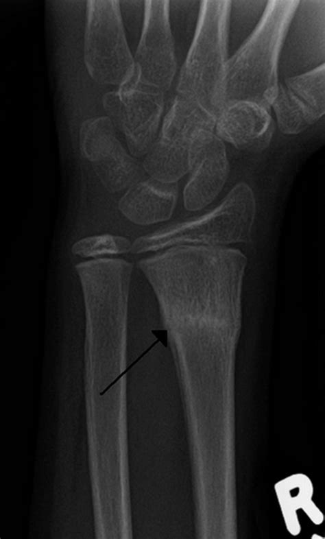 Buckle Fracture Radius Ulna Wrist Finger Symptoms And