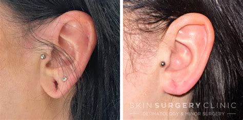 Stretched Earlobe Reconstruction Leeds Skin Surgery Clinic £740