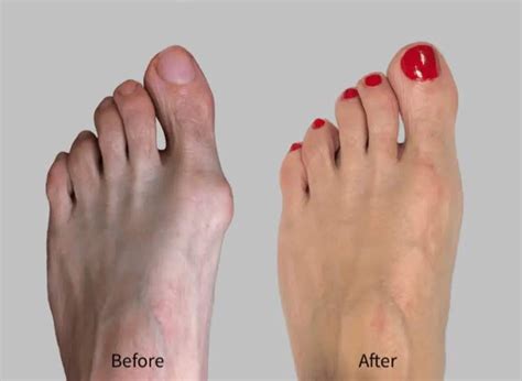 4 Things Doctors Know About Minimally Invasive Hallux Valgus But