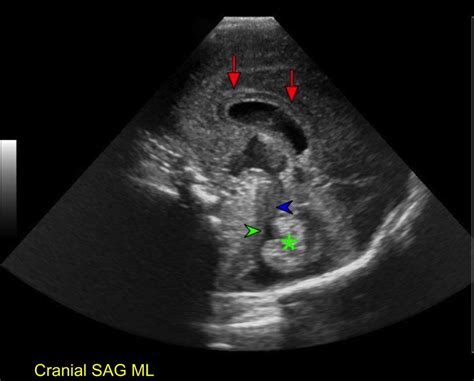 Normal Neonatal Brain Ultrasound Anatomy