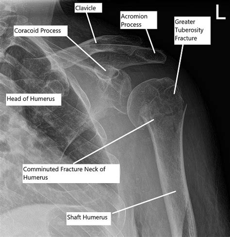 Case Study Three Part Fracture Management Of Left Proximal