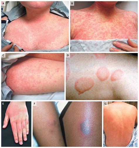 How Long Does It Take For A Drug Reaction Rash To Go Away Allergen 101