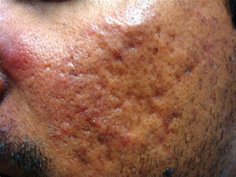 Medical Pictures Info Acne Scar