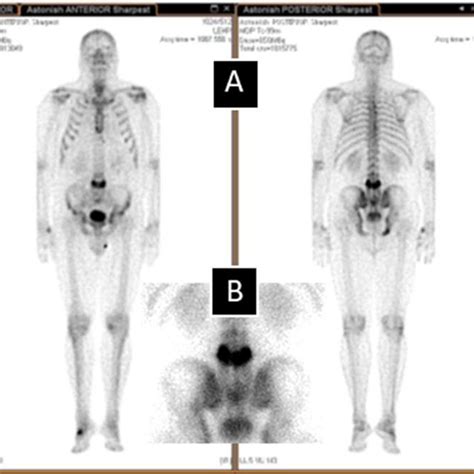 Bone Scan Images A Whole Body Bone Scan Anterior And Posterior