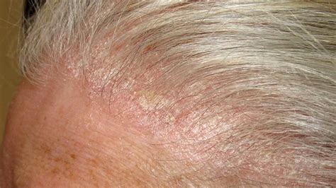 Symptoms Of Scalp Psoriasis Pictures Symptoms And Pictures My XXX Hot