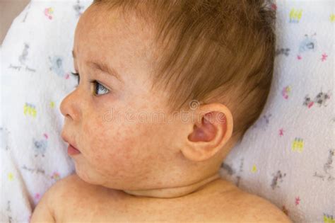 Baby Mit Dermatitisproblem Des Hautausschlags Allergie Die Unter