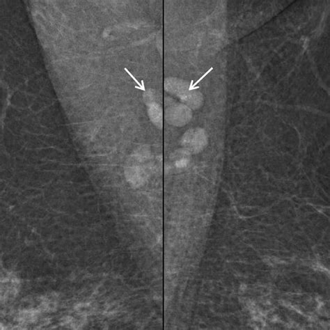 Pdf Bilateral Axillary Node Calcifications A Case Report And