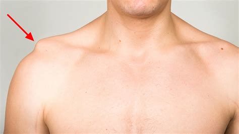 Separated Shoulder Causes Symptoms Exercises Treatment