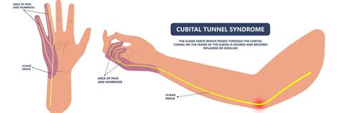 Cubital Tunnel Syndrome Ulnar Nerve Compression Perth Orthopaedic The